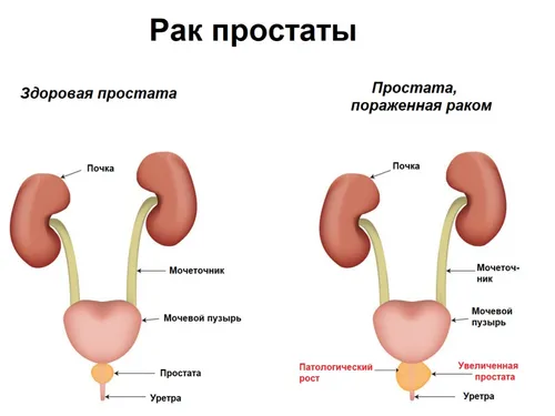 Молочница У Мужчин Фото диаграмма, схема