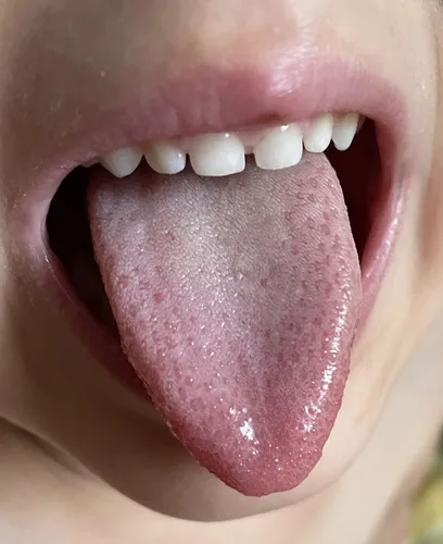 Скарлатина Фото крупный план рта человека