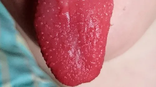 Скарлатина Фото крупный план губ человека
