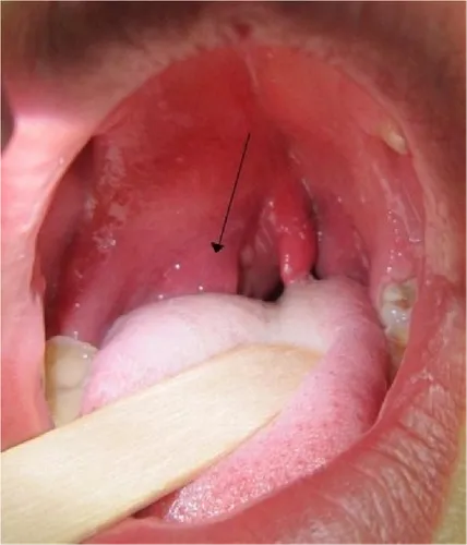 Хронический Тонзиллит Фото крупный план рта человека