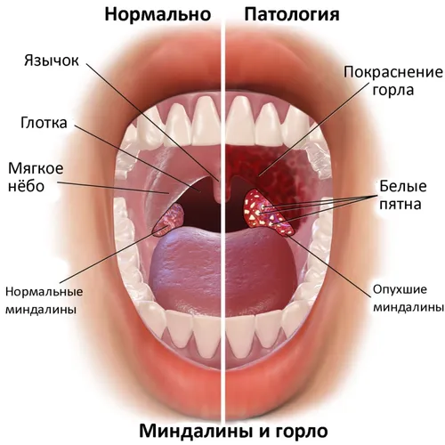 Хронический Тонзиллит Фото фто на айфон