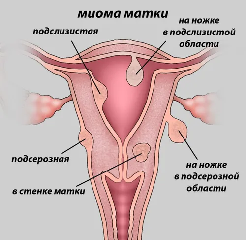 Эндометриоз Выделений Фото в хорошем качестве