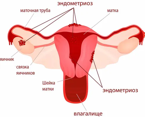Эндометриоз Выделений Фото диаграмма, схема
