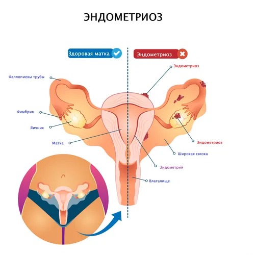 Эндометриоз Выделений Фото рисунок