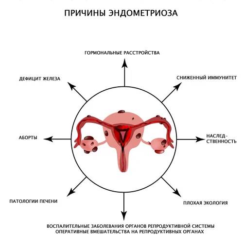 Эндометриоз Выделений Фото для телефона