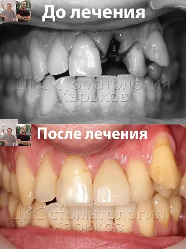 Этапы Заживления Лунки После Удаления Зуба Фото диаграмма