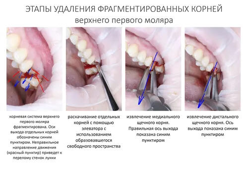 Этапы Заживления Лунки После Удаления Зуба Фото эстетика