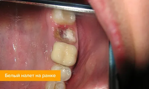 Этапы Заживления Лунки После Удаления Зуба Фото рот человека с открытым ртом ребенка