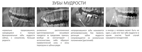 Этапы Заживления Лунки После Удаления Зуба Фото для iPhone