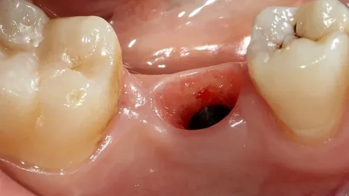 Этапы Заживления Лунки После Удаления Зуба Фото крупный план рта человека