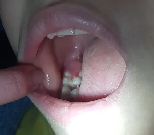 Этапы Заживления Лунки После Удаления Зуба Фото человек, держащий рот ребенка