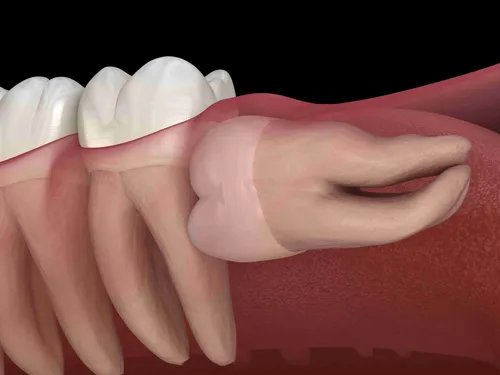 Этапы Заживления Лунки После Удаления Зуба Фото рука человека крупным планом