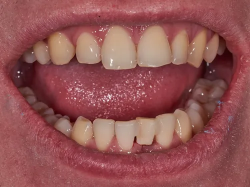 Этапы Заживления Лунки После Удаления Зуба Фото крупный план рта