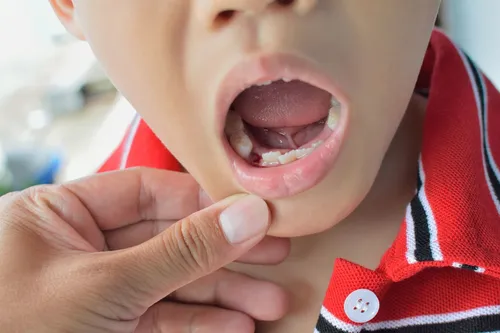 Этапы Заживления Лунки После Удаления Зуба Фото ребенок с открытым ртом