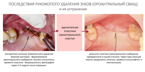 Этапы Заживления Лунки После Удаления Зуба Фото коллаж рта и зубов человека