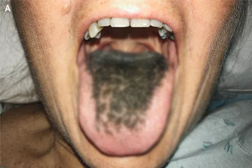 Болезни Языка Фото мужчина с усами