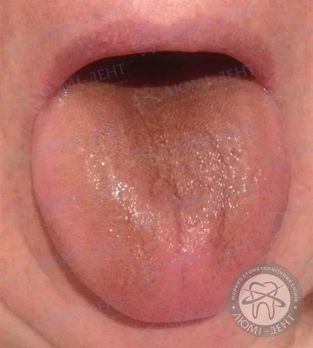 Болезни Языка Фото крупный план губ человека