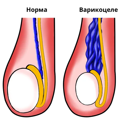 Варикоцеле Фото для iPhone