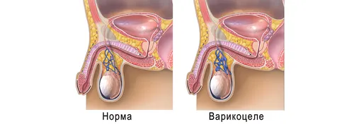 Варикоцеле Фото ноги женщины крупным планом