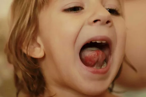 Вирус Коксаки Фото ребенок с открытым ртом