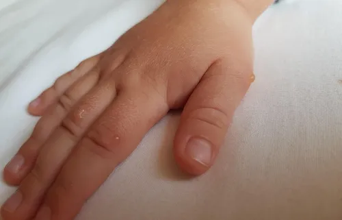 Вирус Коксаки Фото рука ребенка крупным планом