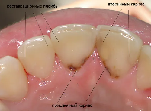 Кариес Фото крупный план рта человека