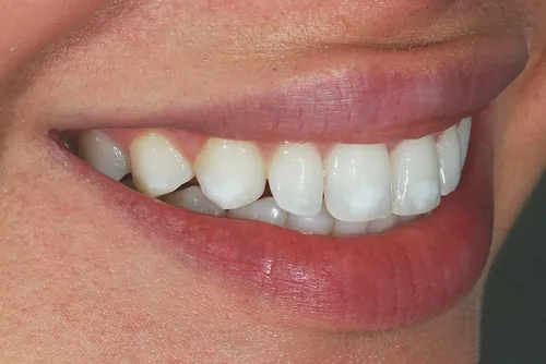 Кариес Фото крупный план рта человека с показом зубов
