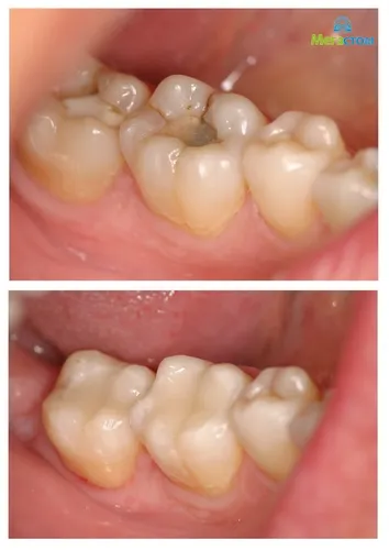 Кариес Фото закрыть рот человека зубами и зубами