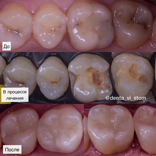 Кариес Фото группа розовых и белых предметов