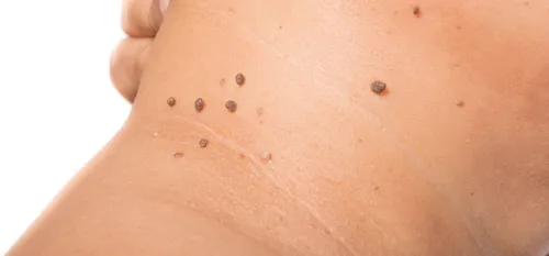 Кондиломы На Малых Губах Фото крупный план кожи человека