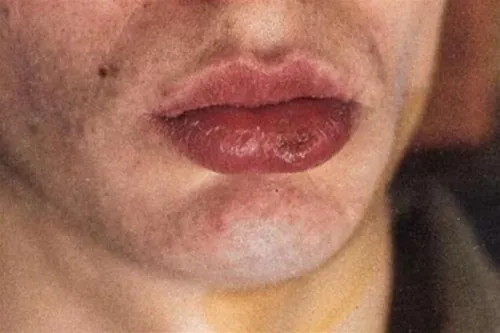 Кондиломы На Малых Губах Фото крупный план рта человека