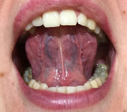 Кондиломы Фото крупный план рта человека