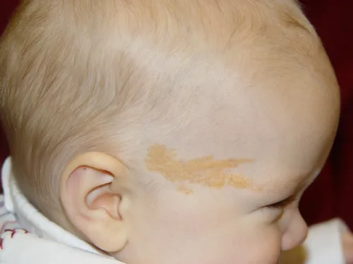 Невус Фото ребенок с сыпью на лице