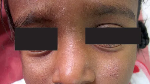 Нейродермит Фото крупный план мужчины с солнцезащитными очками на лице