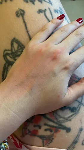 Нейродермит Фото женская рука с красным лаком для ногтей