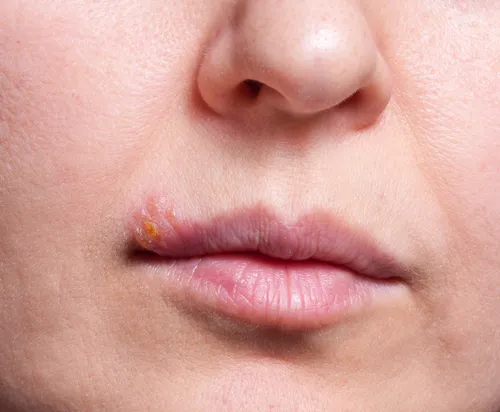 Нервный Дерматит Фото крупный план губ человека