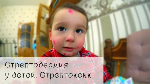 Стрептодермия Фото ребенок смотрит в камеру