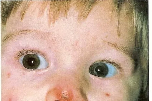 Стрептодермия Фото крупный план детских глаз