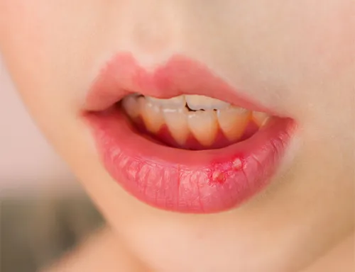 Стрептодермия Фото крупный план губ человека