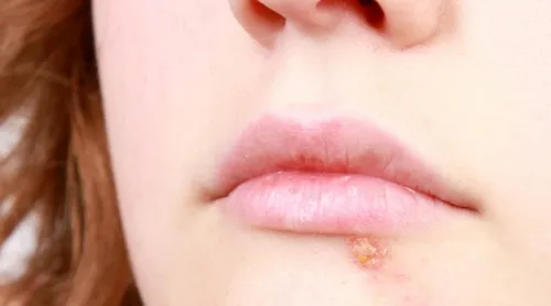 Стрептодермия Фото крупный план женских губ