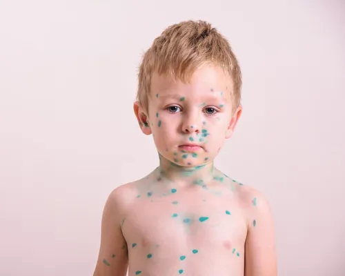 Стрептодермия Фото ребенок с веществом на лице