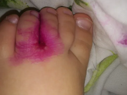 Стрептодермия Фото ножка ребенка с розовой сыпью на ней