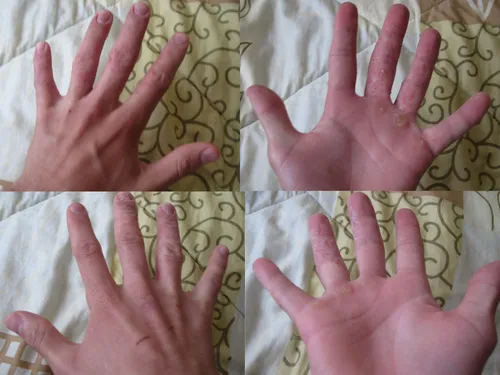 Экзема На Руках Фото группа рук, держащих пальцы