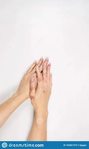 Экзема На Руках Фото пара рук с кольцом