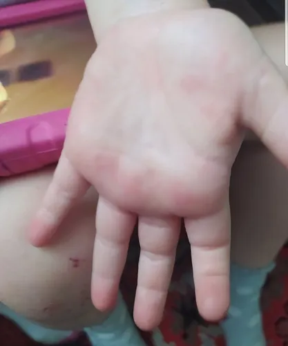 Аллергическая Сыпь У Ребенка Фото человек, держащий ребенка за руку