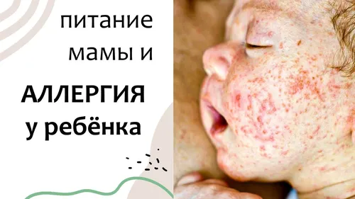 Аллергическая Сыпь У Ребенка Фото мужчина с открытым ртом