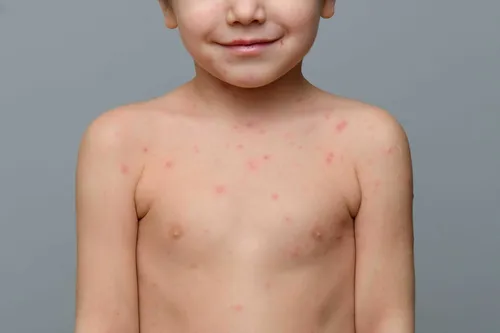 Аллергическая Сыпь У Ребенка Фото ребенок без рубашки