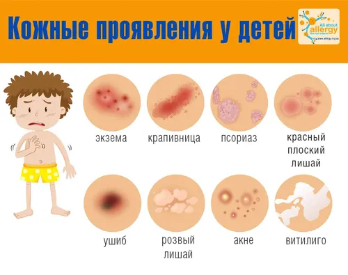 Аллергическая Сыпь У Ребенка Фото диаграмма