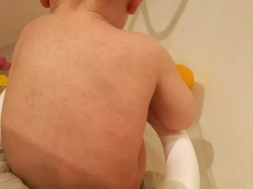 Аллергическая Сыпь У Ребенка Фото крупный план спины человека