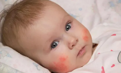 Аллергическая Сыпь У Ребенка Фото ребенок, лежащий на одеяле